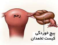 کیست روی تخمدان
