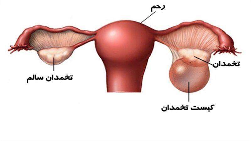 کیست روی تخمدان