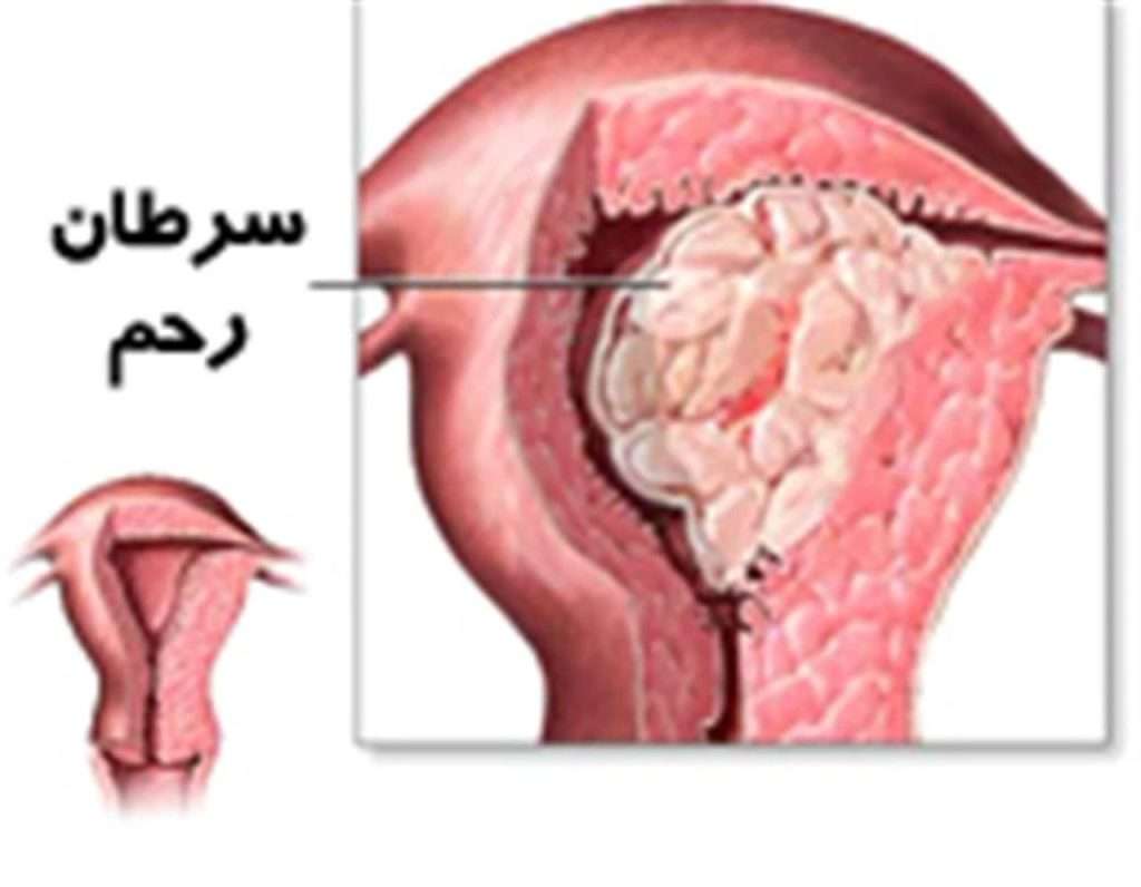 مراجعه به بهترین پروفسور زنان و زایمان سرطان رحم