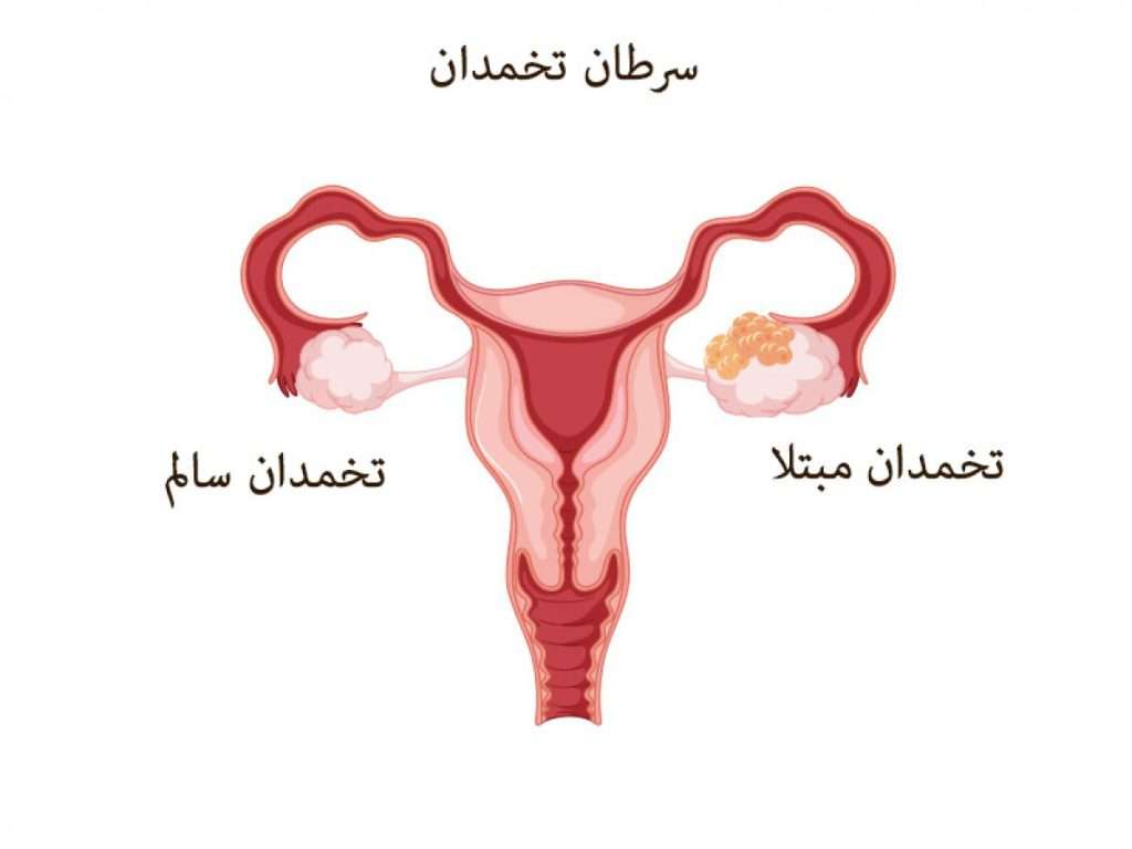 سرطان تخمدان
