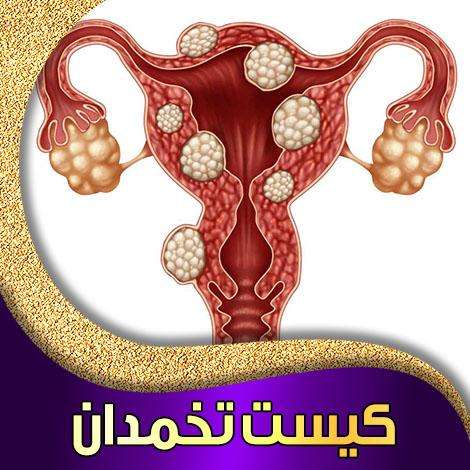 کیست روی تخمدان