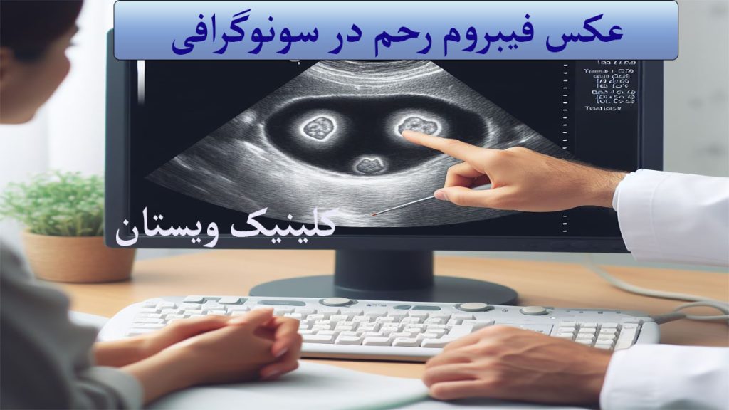 سونوگرافی فیبروم رحم نمایش داده می شود