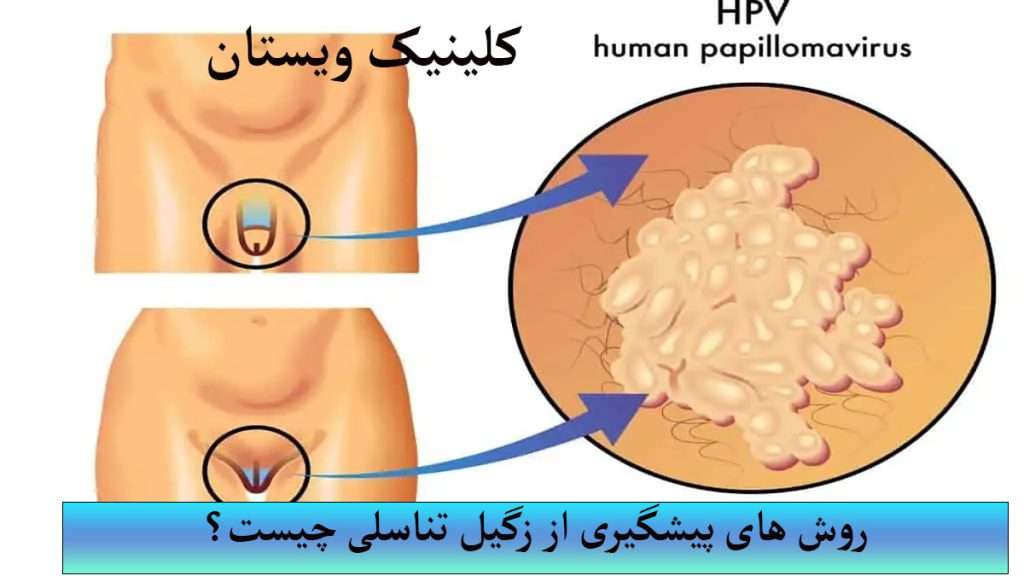 زگیل تناسلی مردانه و زنانه نمایش داده می شود