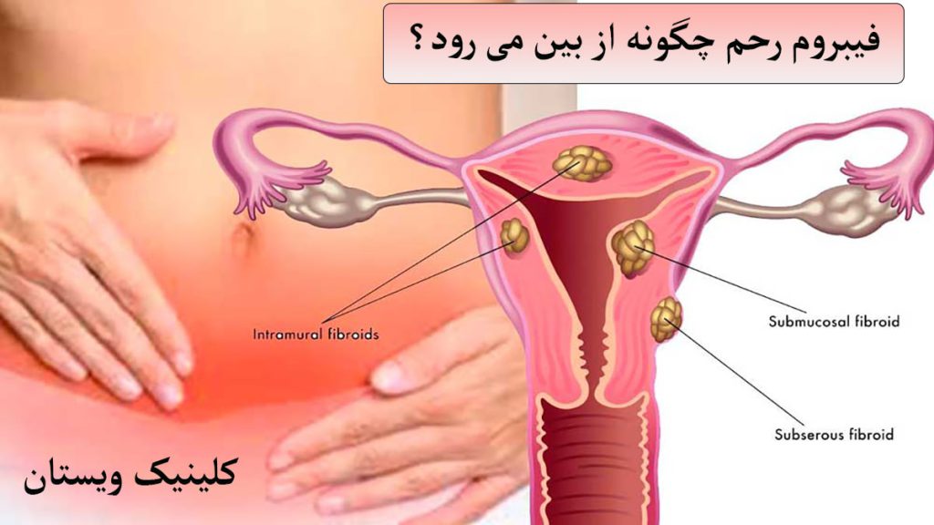 رحم فیبروم شده شخصی نمایش داده می شود