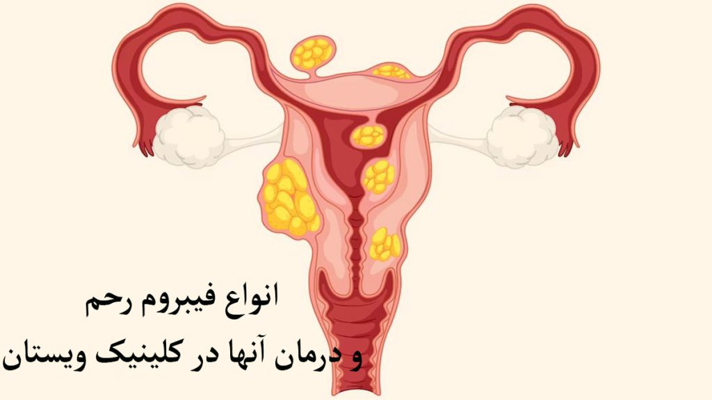 فیبروم رحم نمایش داده می شود