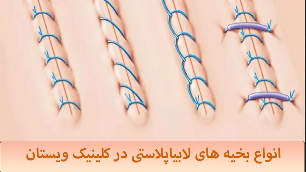 انواع بخیه ها نمایش داده می شود