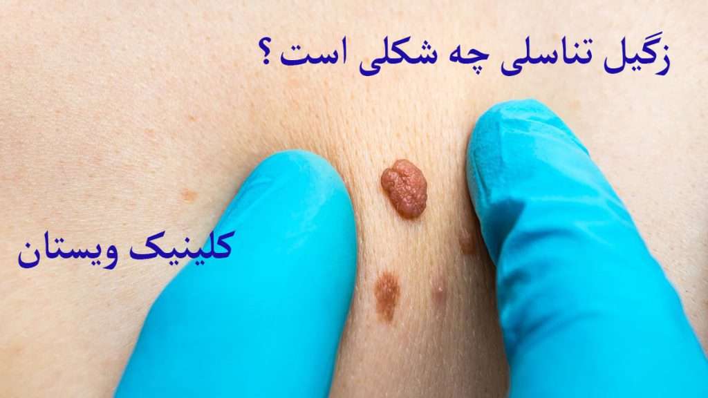 زگیل روی پوست را نمایش می دهد