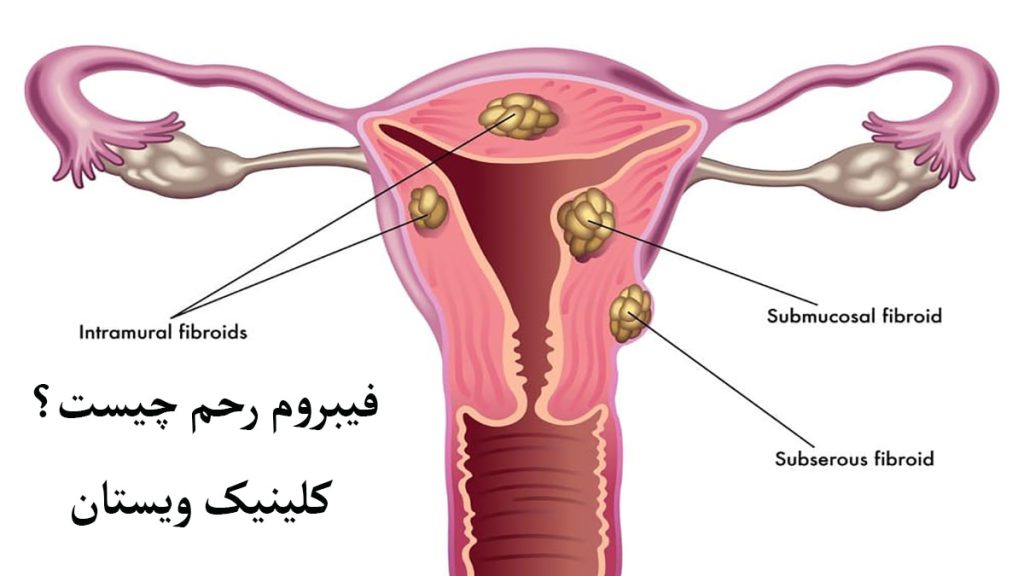 فیبروم رحم نمایش داده می شود