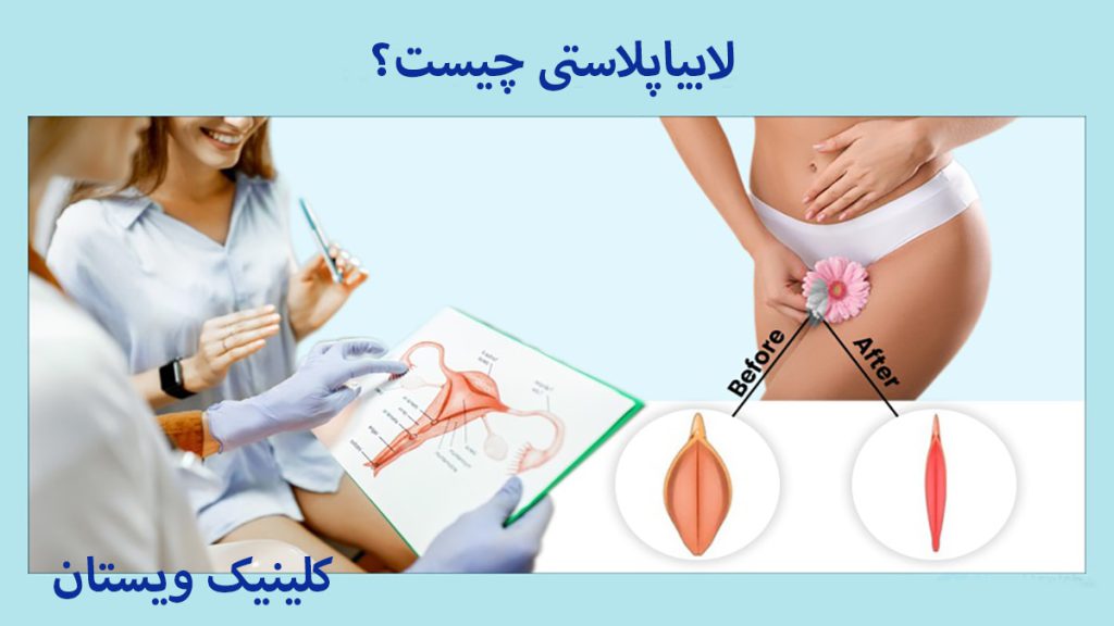 یک جراح زنان و عمل لابیاپلاستی نوشته ای در خصوص لابیاپلاستی چیست؟ نمایش داده می شود