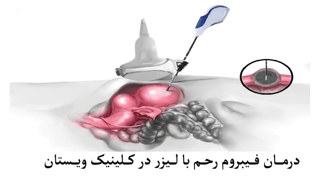 از لیزر برای درمان فیبروم رحم استفاده شده است