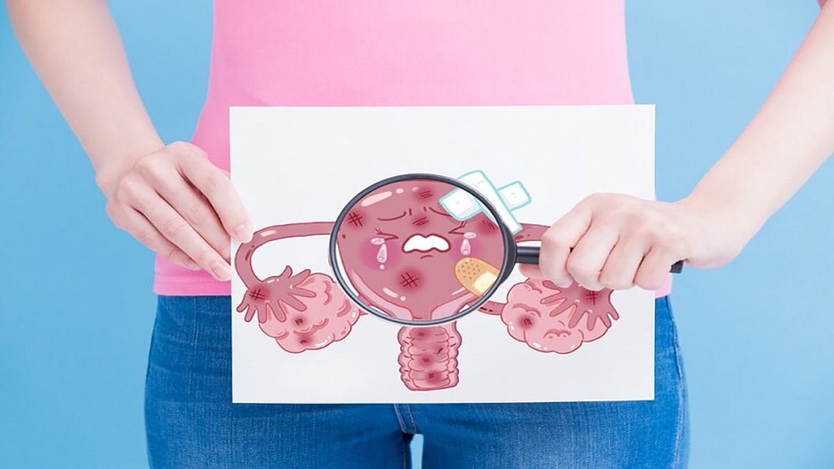 نشانه های تنبلی تخمدان علائم تنبلی تخمدان در دختر