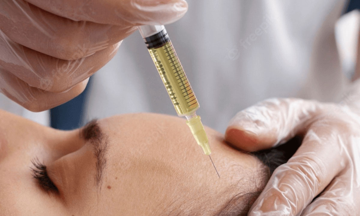 PRP مو تزریق موی سر