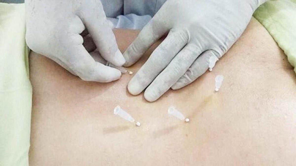 مراقبتهای بعد از امبدینگ لاغری