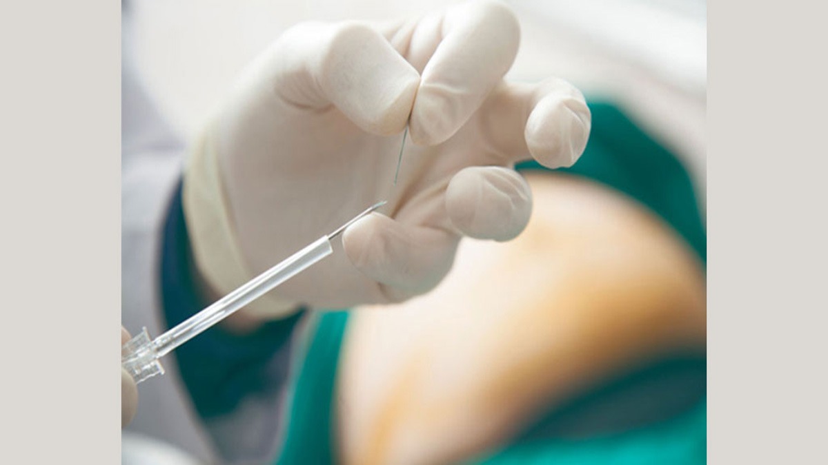 نخ طب سوزنی نخ امبدینگ برای لاغری
