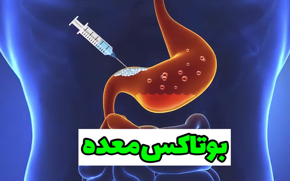 بوتاکس معده چیست