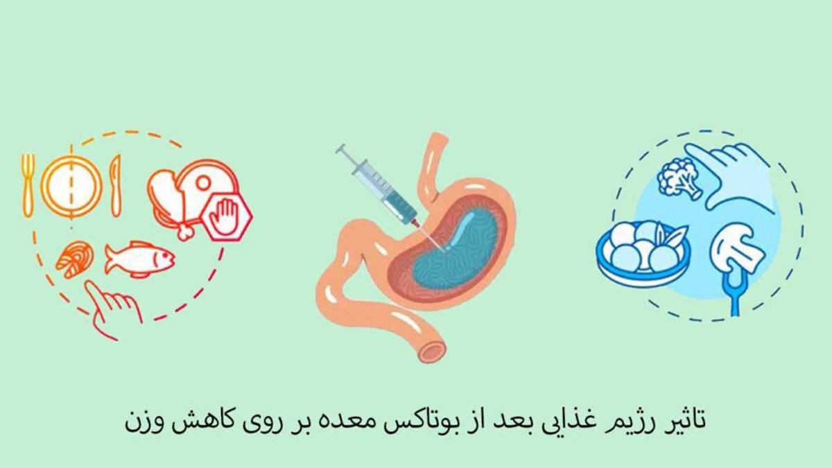 مراقبت های بعد از بوتاکس معده