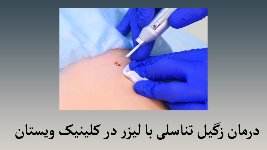 یک پزک در حال استفاده از لیزر برای درمان زگیل