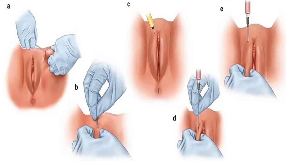 تزریق ژل تاثیر تزریق ژل به واژن
