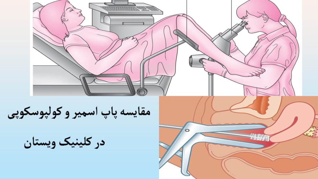فرق پاپ اسمیر و کولپوسکوپی دو تصویر در یک قاب که انجام کولپوسکوپی و پاپ اسمیر را نشان می دهد