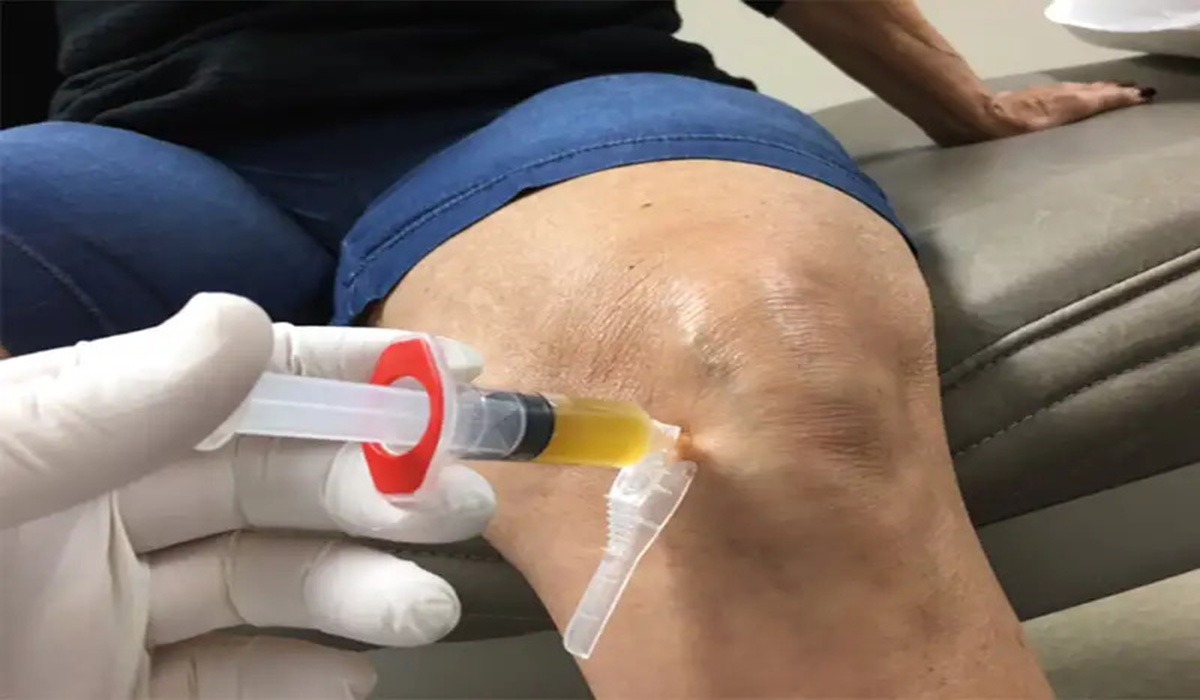 عوارض PRP عوارض پی آر پی