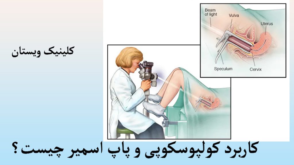 کاربرد کولپوسکوپی یک پزشک در حال انجام کولپوسکوپی و تصویری دیگر از پاپ اسمیر نشان داده می شود