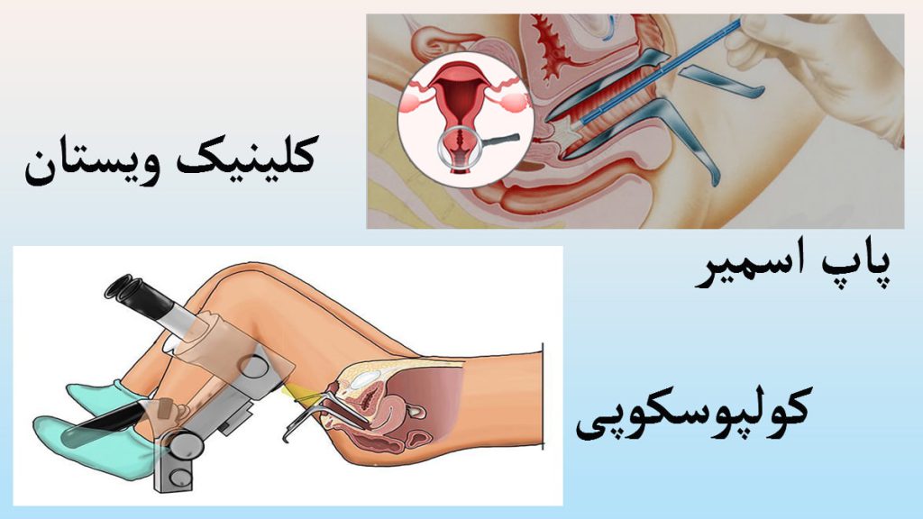 کولپوسکوپی و پاپ اسمیر کولپوسکوپی و پاپ اسمیر بصورت جداگانه در دو تصویر دیده می شود - فرق پاپ اسمیر و کولپوسکوپی