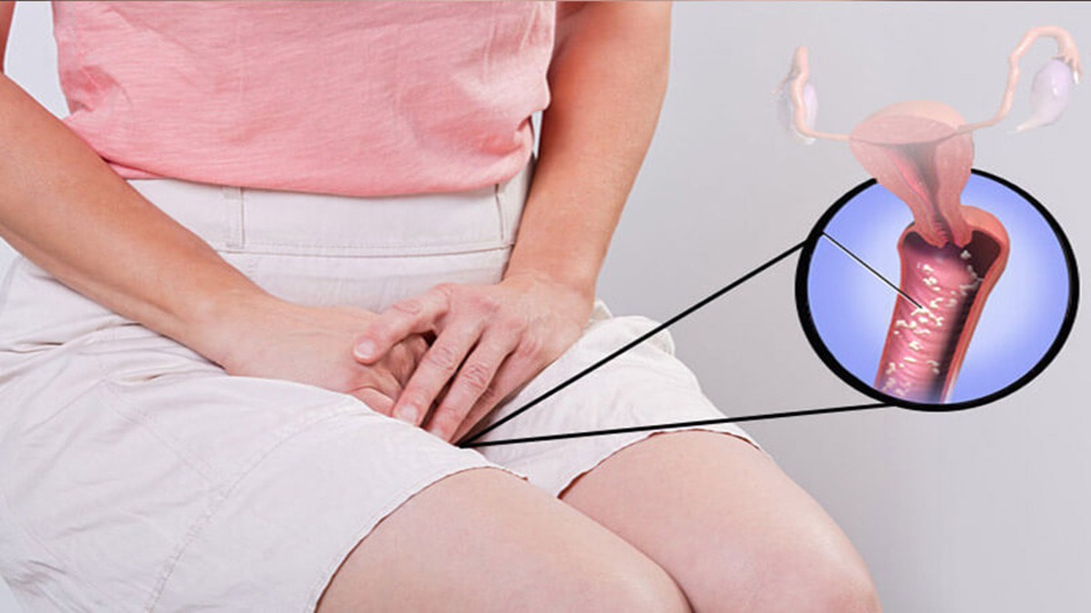 عفونت زنان پنیری شکل+ قرص برای عفونت قارچی واژن