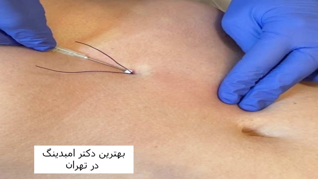 هزینه امبدینگ شکم در سال 1403