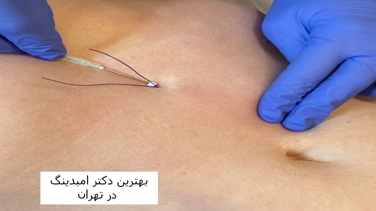هزینه امبدینگ شکم در سال 1403