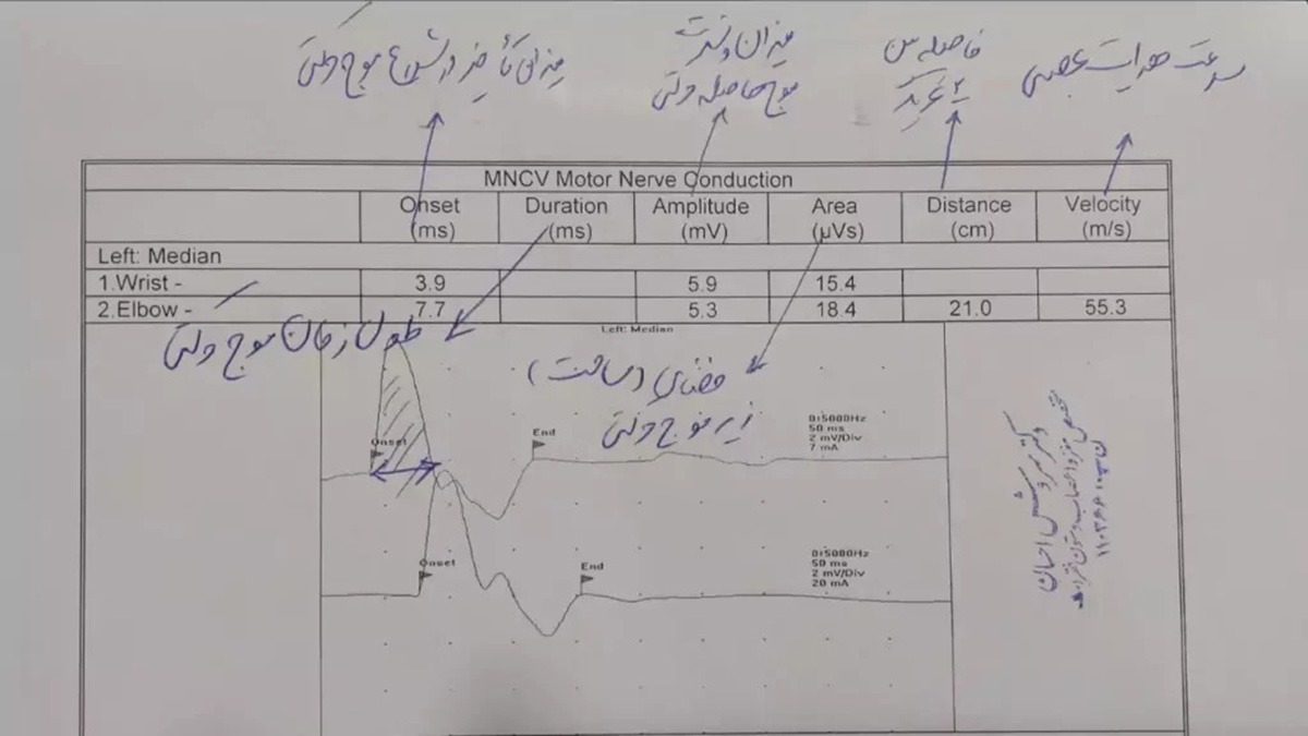 تفسیر الکترومیوگرافی تفسیر جواب نوار عصب و عضله emg