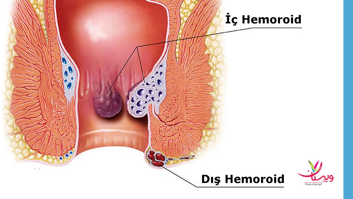 پیشگیری از مشکلات دنبالچه پیشگیری از عفونت دنبالچه