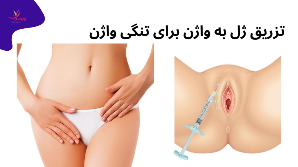 بافتهای واژن تزریق ژل به واژن بهتره یا چربی برای تنگی واژن