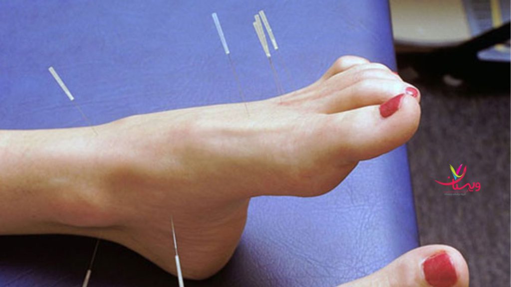 طب سوزنی برای اعصاب پا