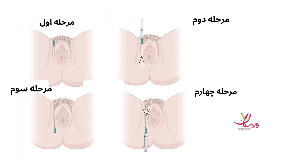 کیا تزریق ژل به واژن داشتن