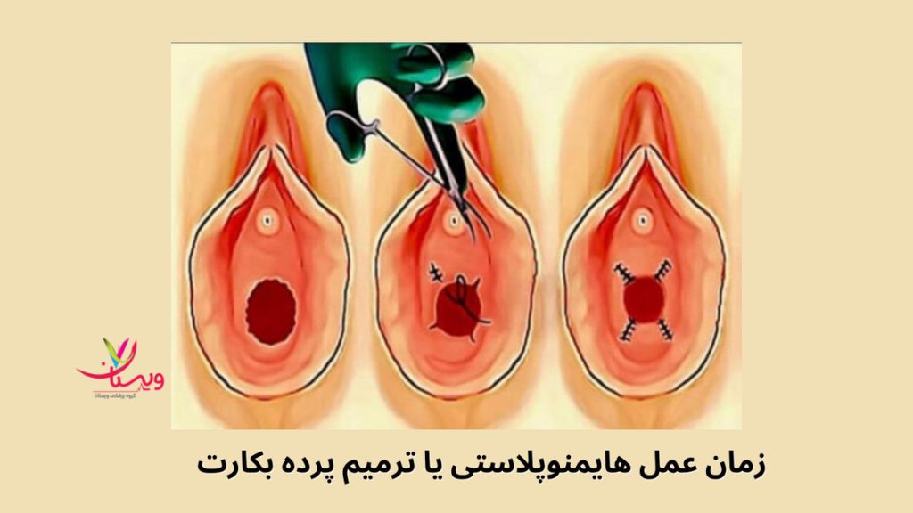 ترمیم بکارت عمل هایمنوپلاستی یا ترمیم پرده بکارت چه زمانی انجام می شود