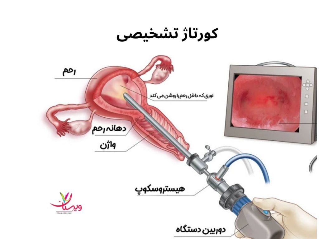 کورتاژ تشخیصی