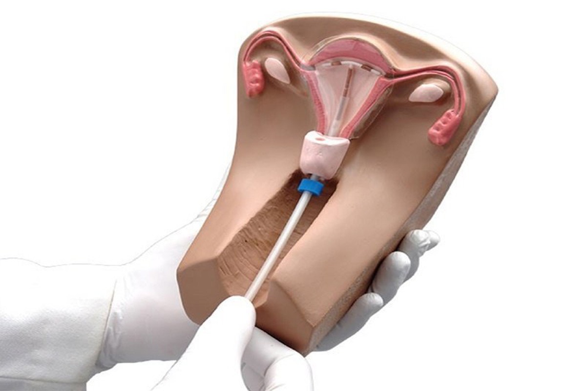 تاثیر دستگاه داخل رحمی (IUD) در لکه بینی