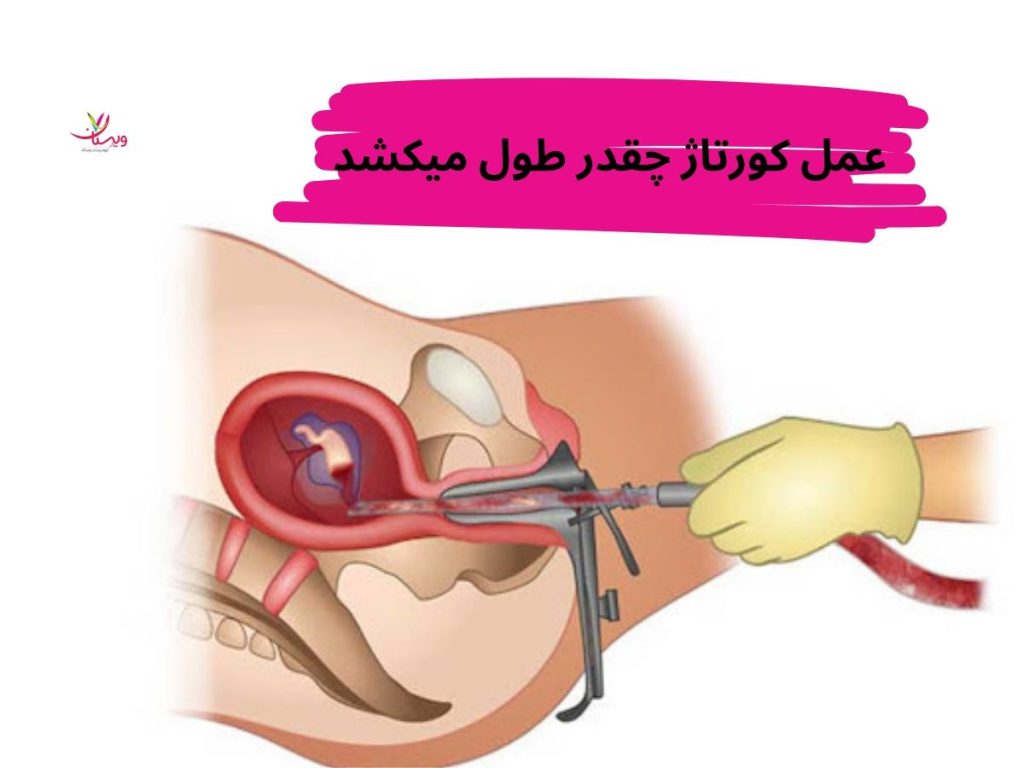 عمل کورتاژ چقدر طول میکشد