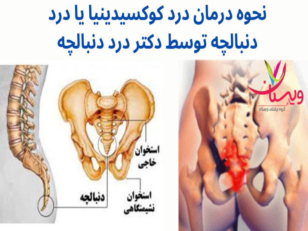 نحوه درمان درد کوکسیدینیا یا درد دنبالچه توسط دکتر درد دنبالچه