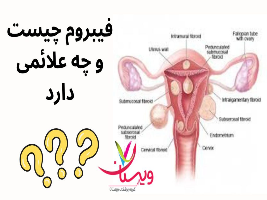 درمانهای هورمونی فیبروم چیست و چه علائمی دارد