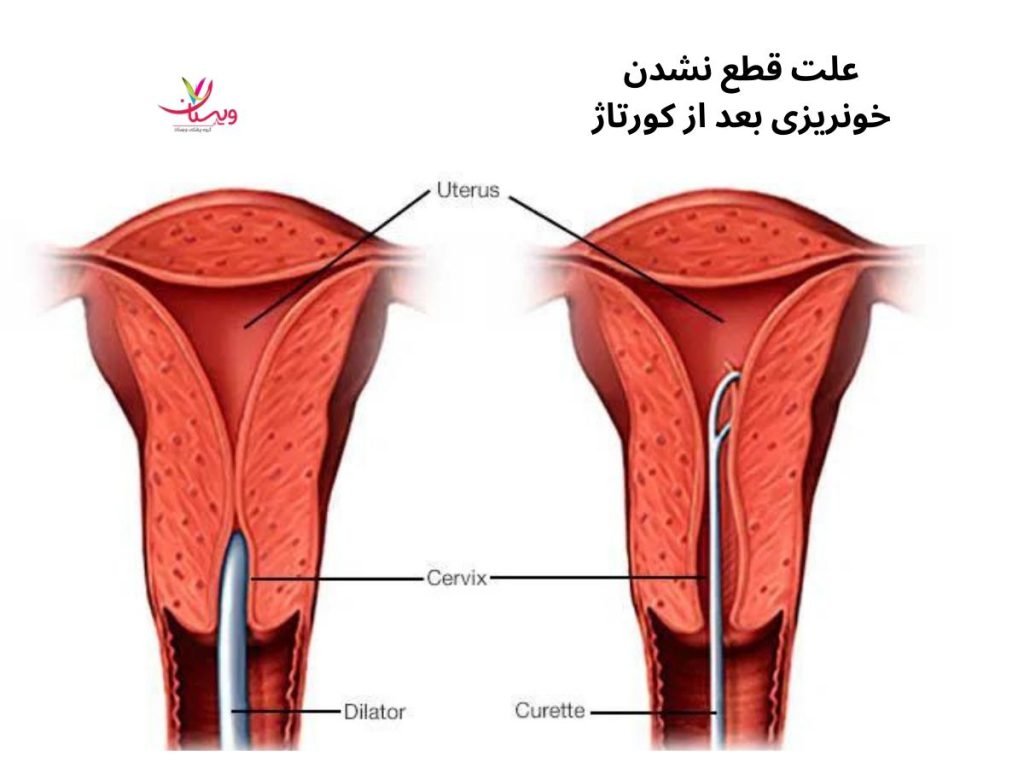 علت قطع نشدن خونریزی بعد از کورتاژ