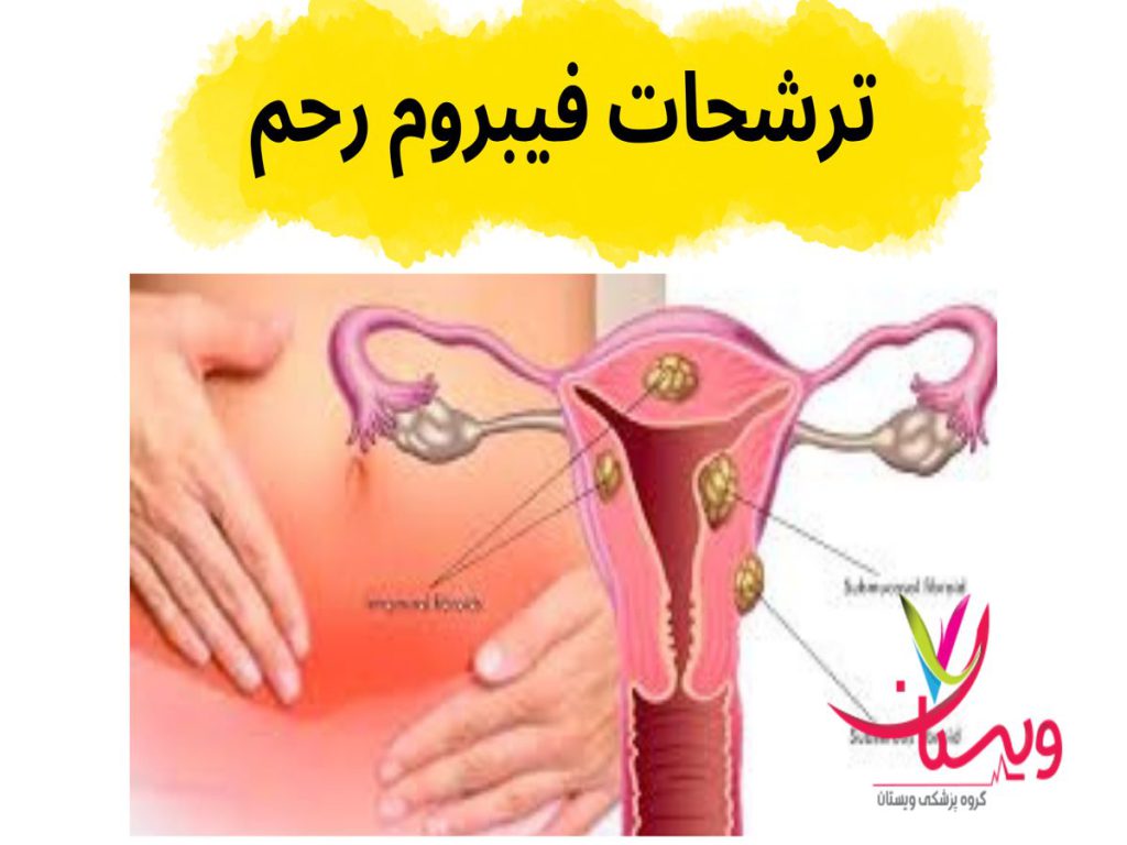 درد و ناراحتی در ناحیه شکم ترشحات فیبروم رحم
