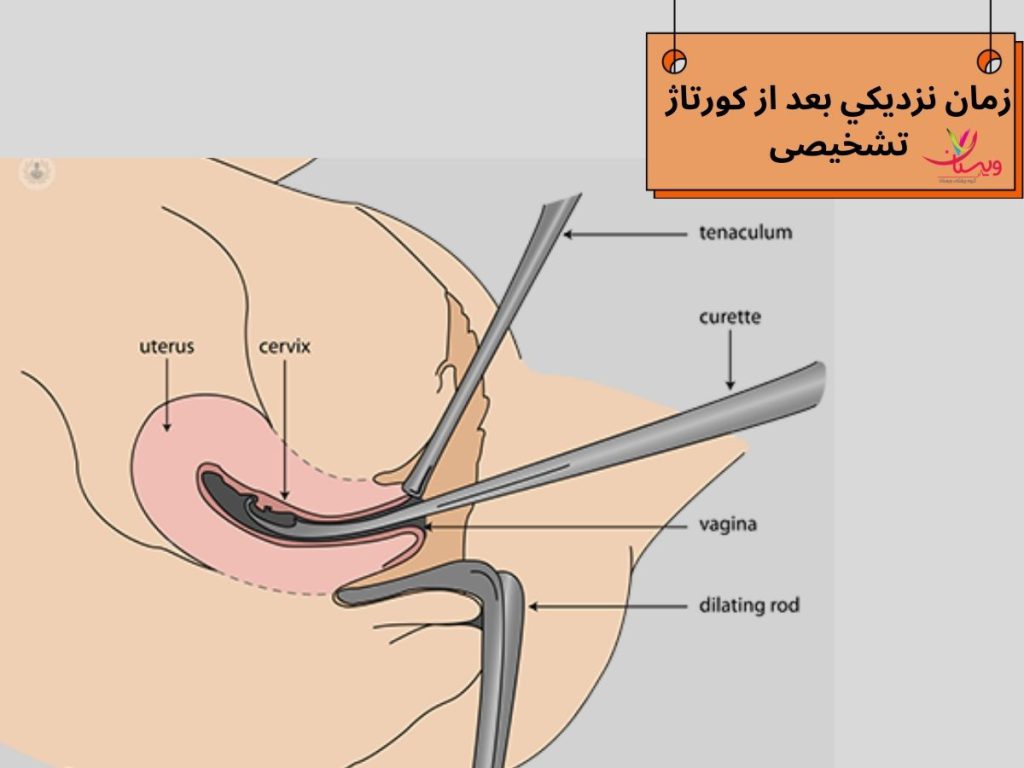 زمان نزديكي بعد از كورتاژ تشخیصی