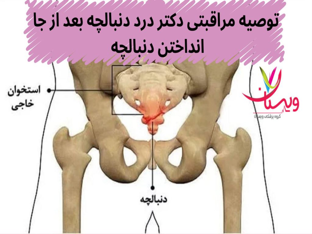 توصیه مراقبتی دکتر درد دنبالچه بعد از جا انداختن دنبالچه