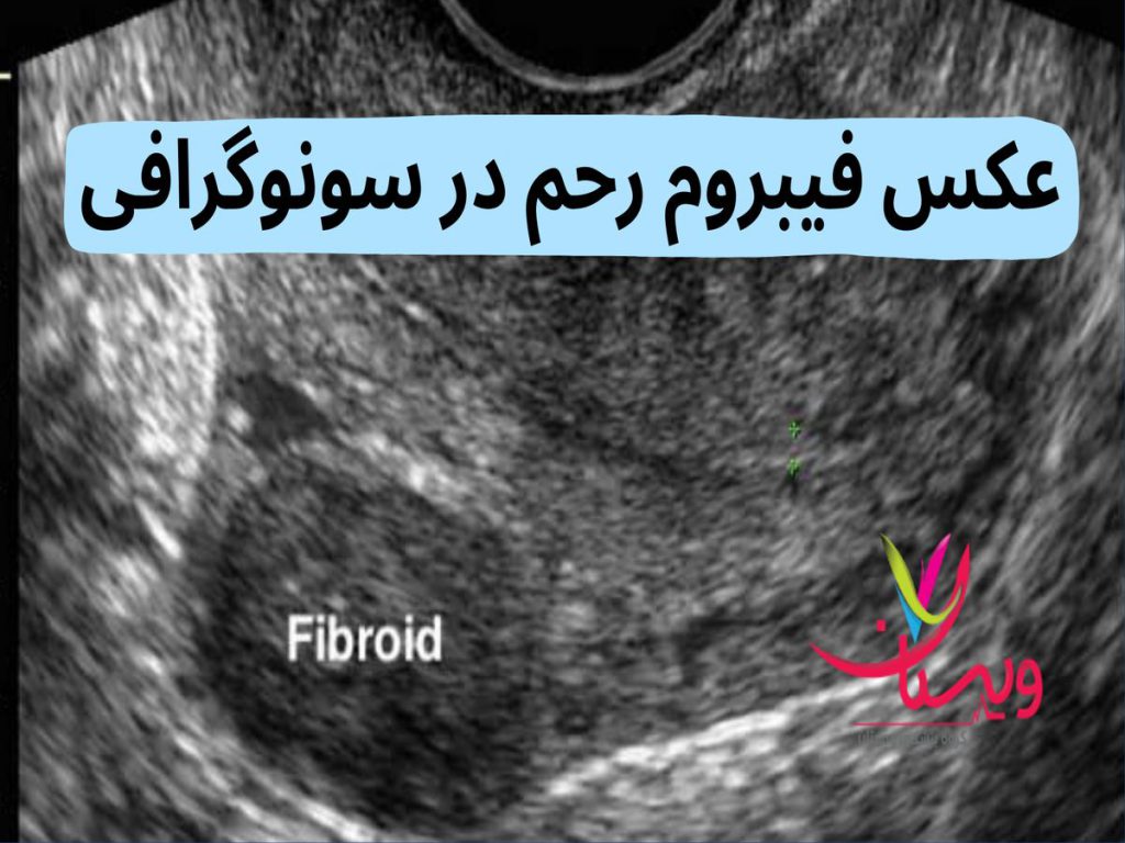 تومورهای خوشخیم عکس فیبروم رحم در سونوگرافی