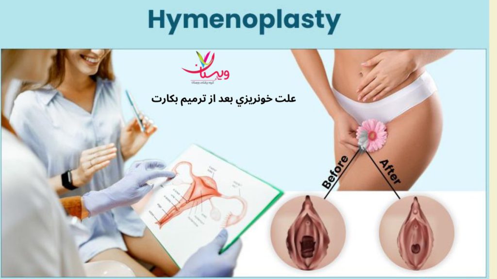 عمل هایمنوپلاستی علت خونريزي بعد از ترميم بكارت