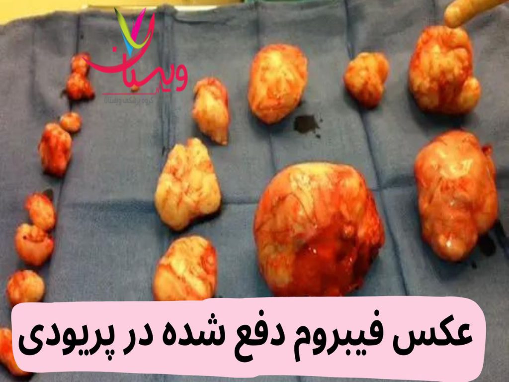 دفع فیبروم عکس فیبروم دفع شده در پریودی