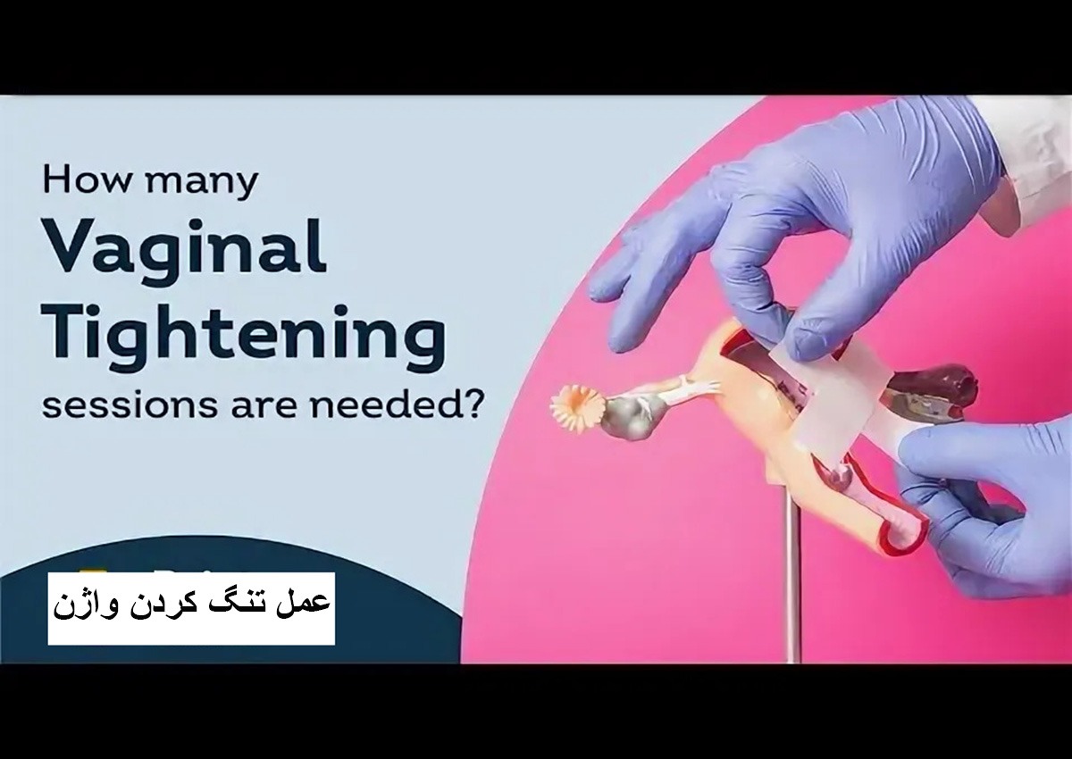 تنگ کردن واژن با لیزر + هزینه 1403 + ماندگاری عمل پرینورافی!