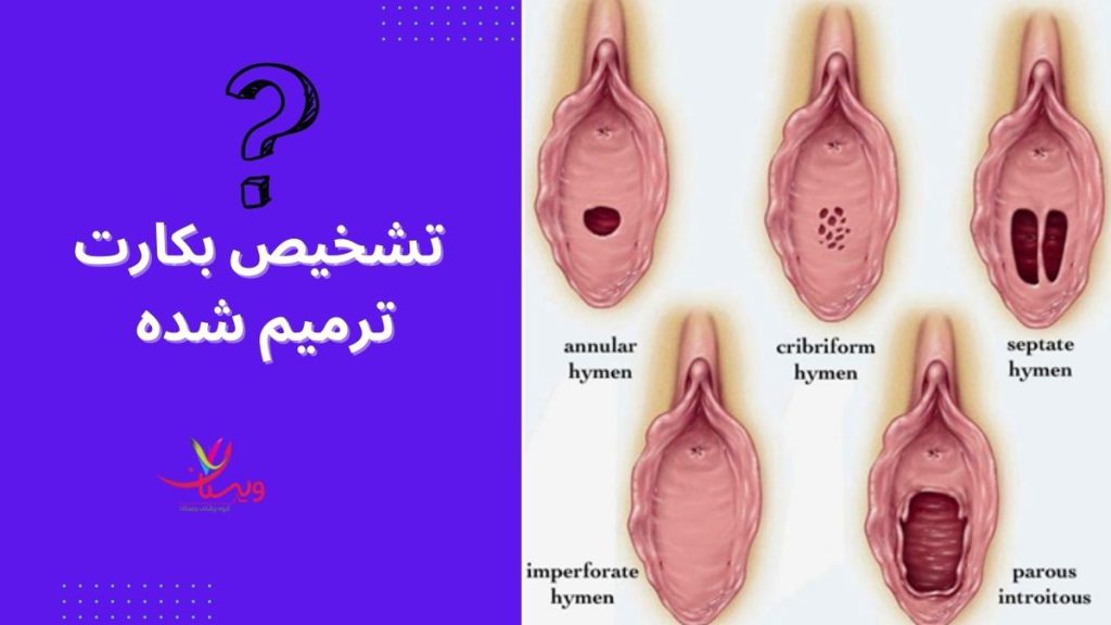 آیا ترميم بكارت قابل تشخيص است
