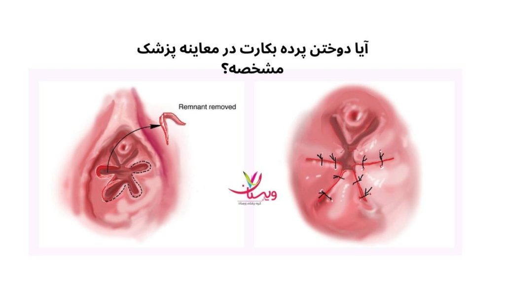 آیا دوختن پرده بکارت در معاینه پزشک مشخص است